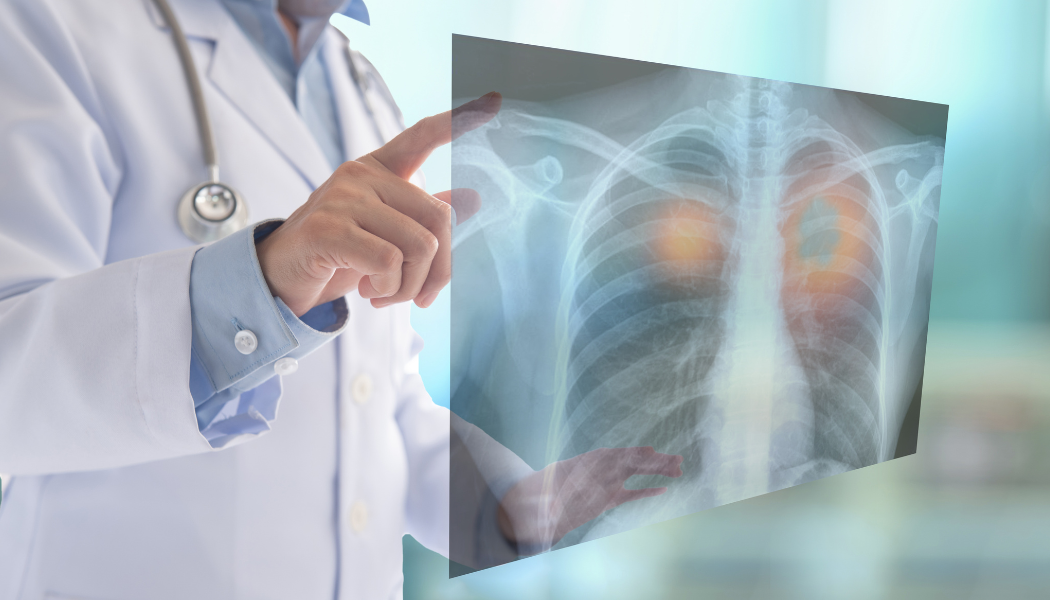 Early Cancer Detection in the Middle East: Why Technology Alone is Not Enough